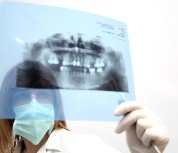 Estrazione dei denti del giudizio Estrazione dei denti del giudizio